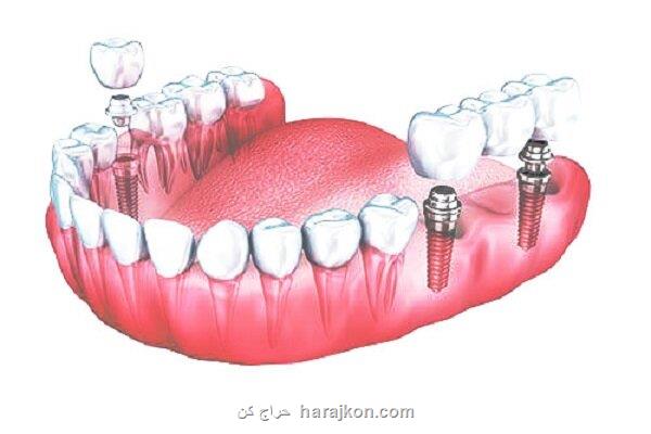 فهرست مرکز کاشت دندان در تهران