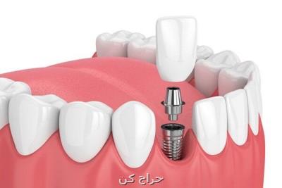 ایمپلنت دندان چیست و انواع ایمپلنت دندان