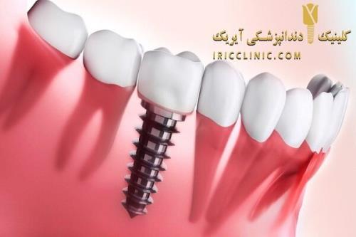هزینه ایمپلنت دندان در تهران (تخفیف ویژه ایمپلنت دندان اقساطی)