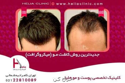 جدید ترین روش كاشت مو در ایران چیست ؟